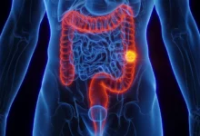 علماء يكتشفون بروتينًا يبطئ نمو سرطان القولون